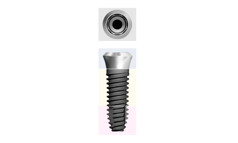 MAIN PARTS OF AN IMPLANT